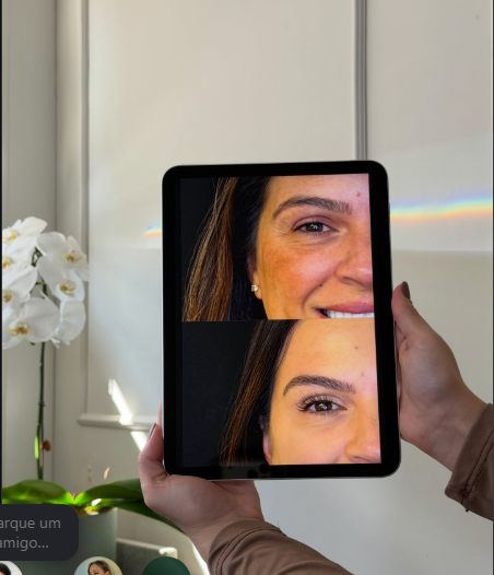 Antes e depois de harmonização facial