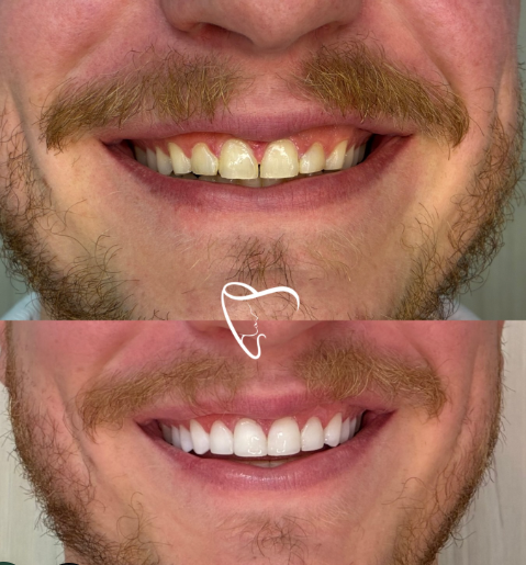 Antes e depois de facetas em resina