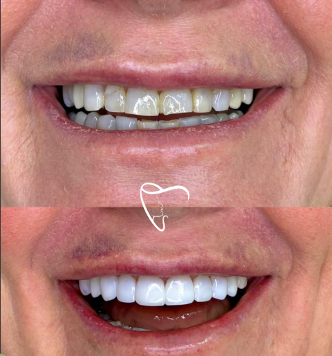 Antes e depois de lentes de resina