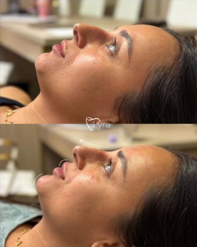Antes e depois de perfiloplastia facial