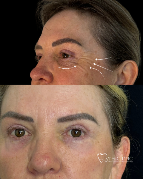 Antes e depois de Skin Eyes, tratamento para região dos olhos